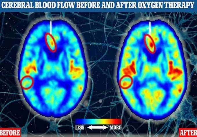 Ressonância magnética mostra fluxo sanguíneo antes (à esquerda) e depois (à direita) em participantes humanos tratados com oxigenoterapia - Daily Mail/Divulgação