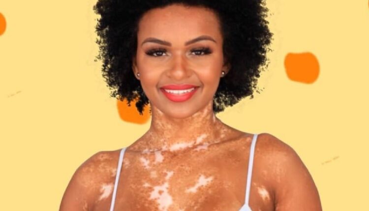 Participante do BBB, Natália Deodato, desabafou durante o programa sobre preconceito contra pessoas que têm vitiligo. Modelo e designer de unhas tem doença em várias partes do corpo. - FOto: Reprodução/Redes Sociais