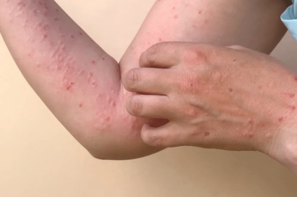 Sintomas incluem (adenomegalia) ínguas e bolhas no corpo - Foto: Reprodução Internet
