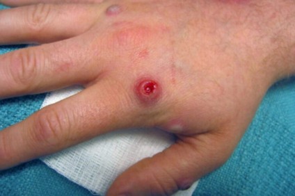 MS registra 3 novos casos de monkeipox em 24h - Foto: Divulgação Agência Brasil