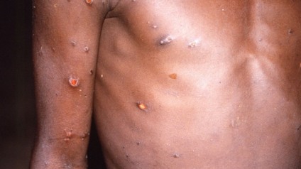 Pacientes que testaram positivo apresentaram febre, dor de cabeça e feridas na pele - Foto: Divulgação Agência Brasil
