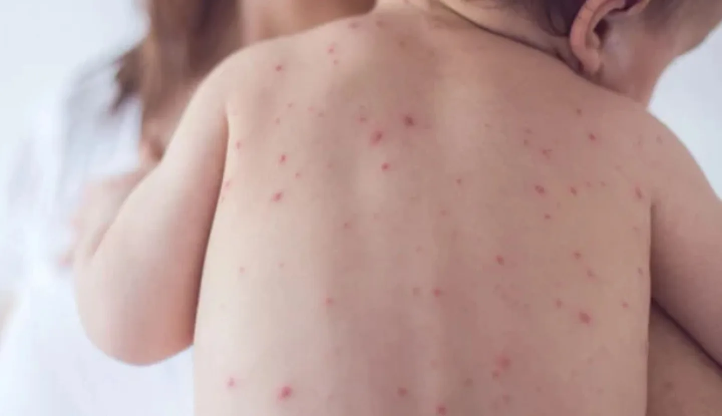 Doença é altamente contagiosa e as crianças são mais susceptíveis ao vírus - Foto: Getty Images/SouthAgency