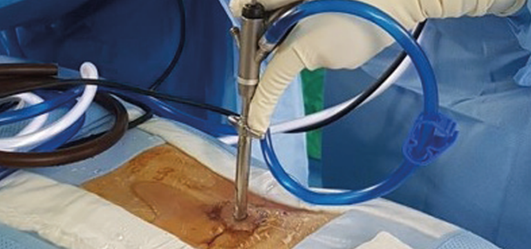 Cirurgia endoscópica reduz pela metade tempo do procedimento e de recuperação do paciente - Foto: Reprodução/ Revista Saúde