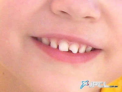 Cada humano possui 20 dentes de leite, dos quais podem ser extraídas células tronco - Cada humano possui 20 dentes de leite, dos quais podem ser extraídas células tronco -