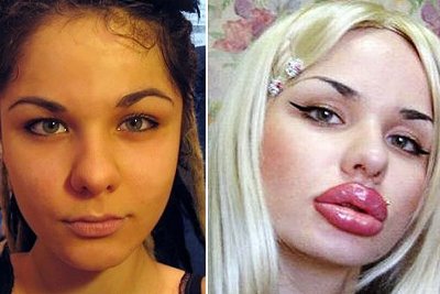 Kristina Rei antes e depois das aplicações -