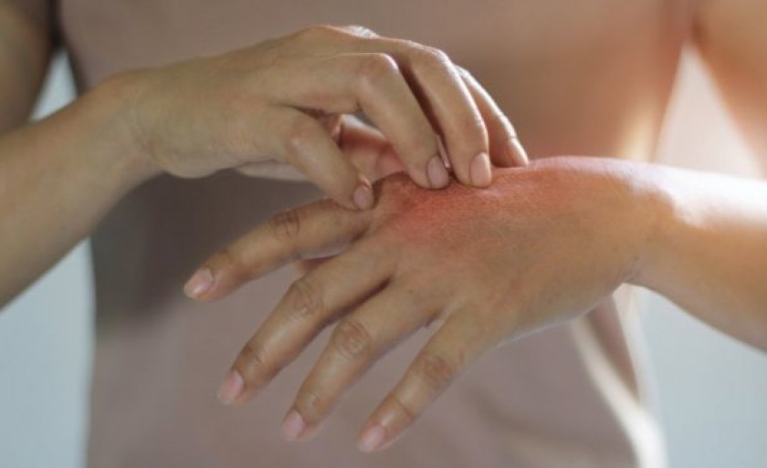 Medicamento para tratamento da psoríase será incorporado pelo SUS - Foto: Getty Images