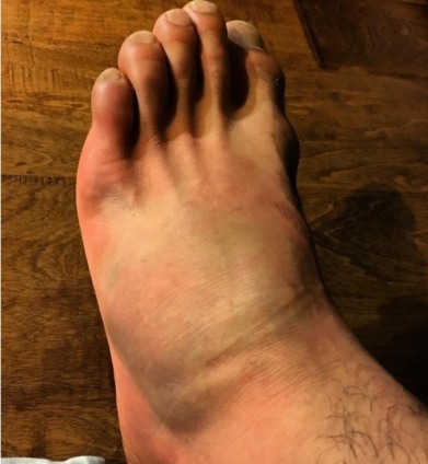 Dos Anjos postou ontem em rede social foto do pé fraturado  - Reprodução/Instagram 