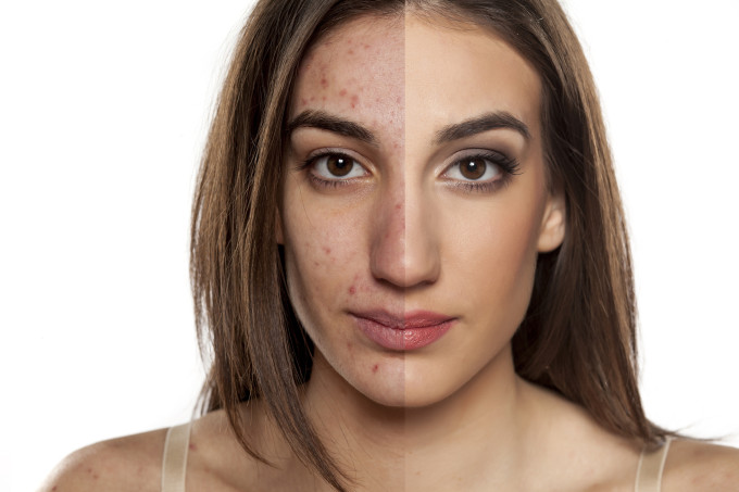 Como proteger a pele com acne em tratamento quando você quiser se maquiar