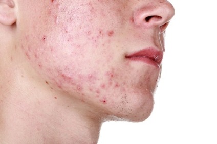 Jovens com incidência de acne sofrem com perdas de oportunidade, tristeza profunda e rejeição - Arquivo/jp