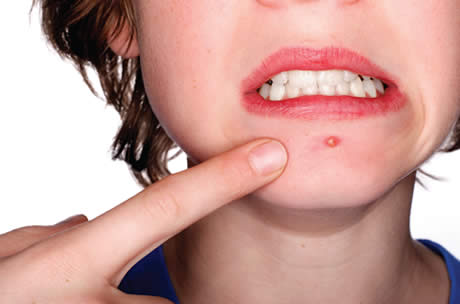 Uma em cada cinco mulheres adultas sofre por acne