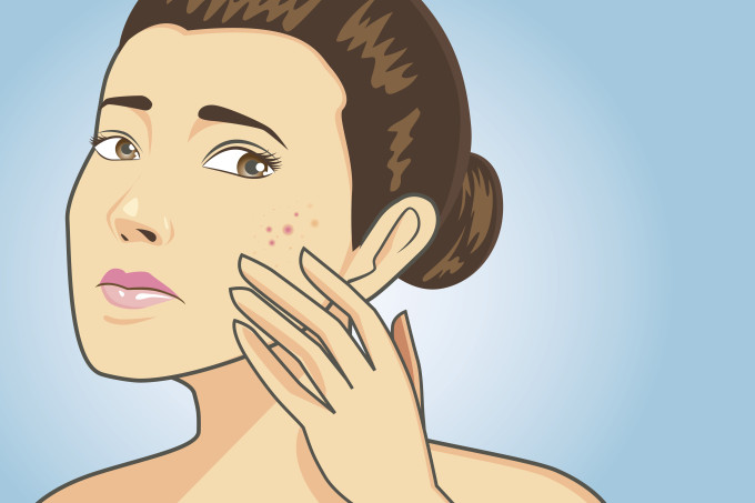 Acne na mulher adulta: 8 dicas para cuidar desse problema crônico Acne na mulher adulta: 8 dicas para cuidar desse problema crônico