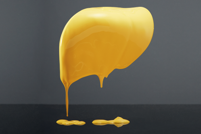 O que é a gordura no fígado? Conheça a esteatose hepática e suas causas O que é a gordura no fígado? Conheça a esteatose hepática e suas causas