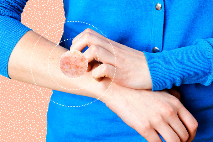 Psoríase: tudo o que você precisa saber sobre o assunto Psoríase: tudo o que você precisa saber sobre o assunto