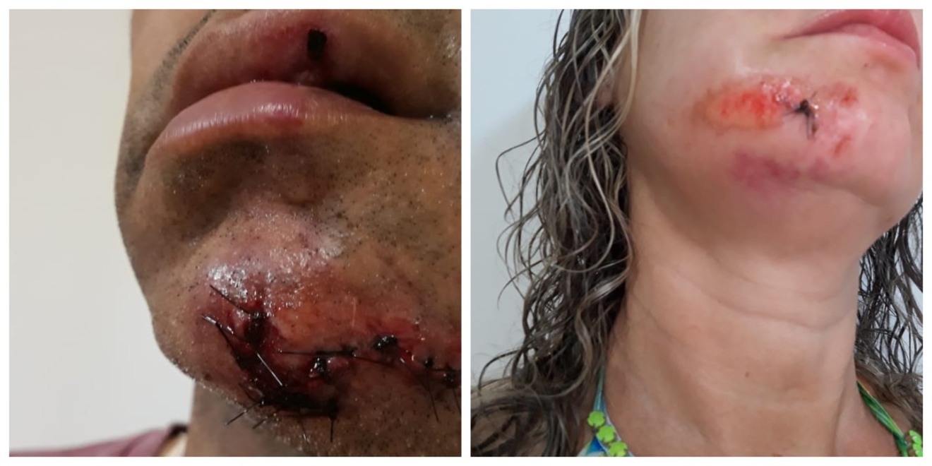 O casal sofreu escoriações pelo corpo, principalmente o rosto - Arquivo Pessoal