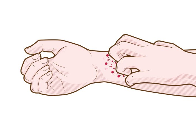 Mais dois remédios para psoríase chegam ao Brasil Mais dois remédios para psoríase chegam ao Brasil