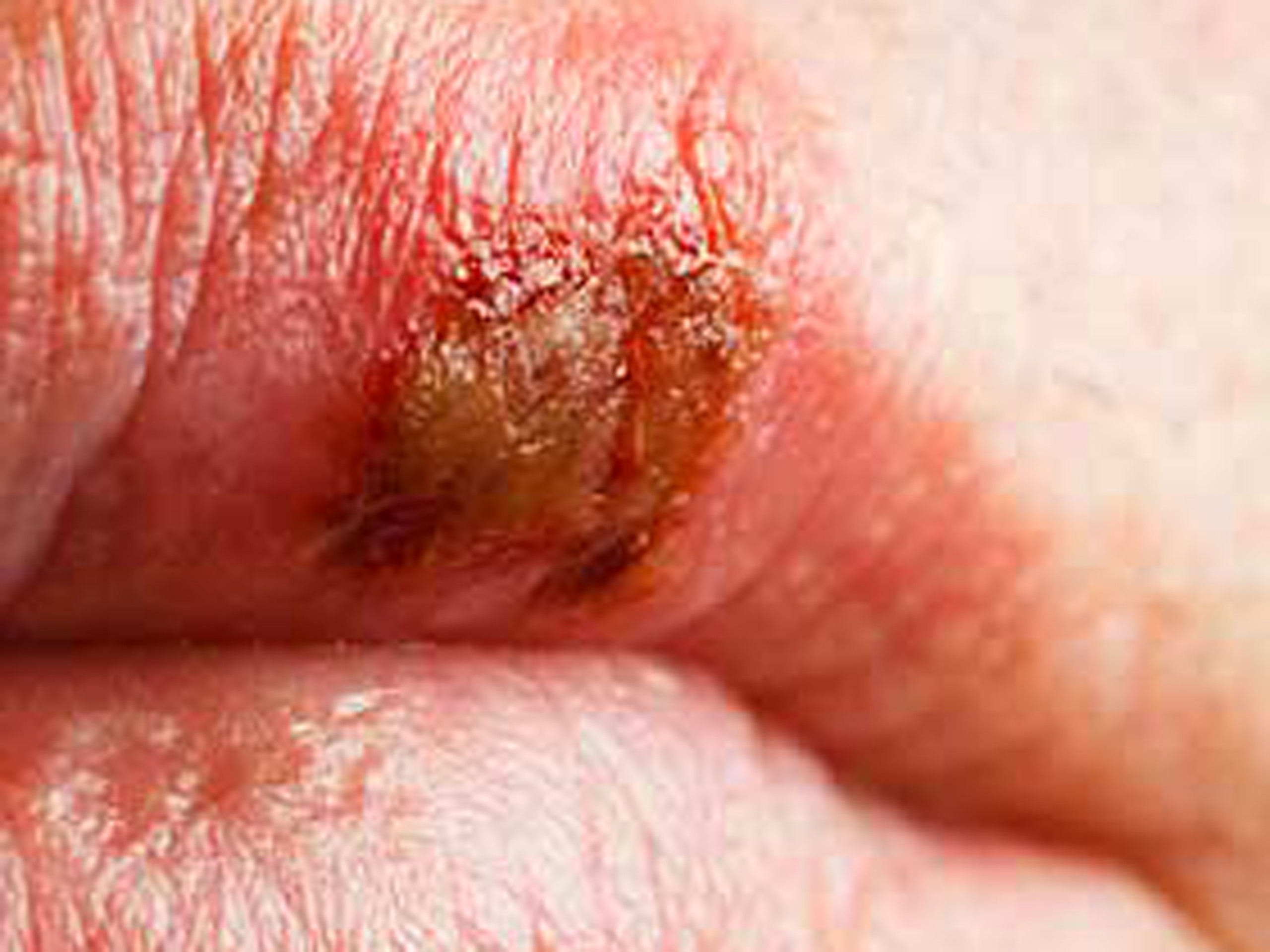 Lesão do herpes labial pode ser ativada por estresse, ansiedade ou mesmo um resfriado - © jeffrey shanes / iStockphoto