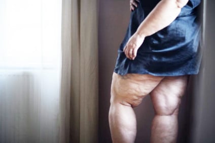 Julho Roxo alerta para lipedema, condição afeta 12,3% das brasileiras