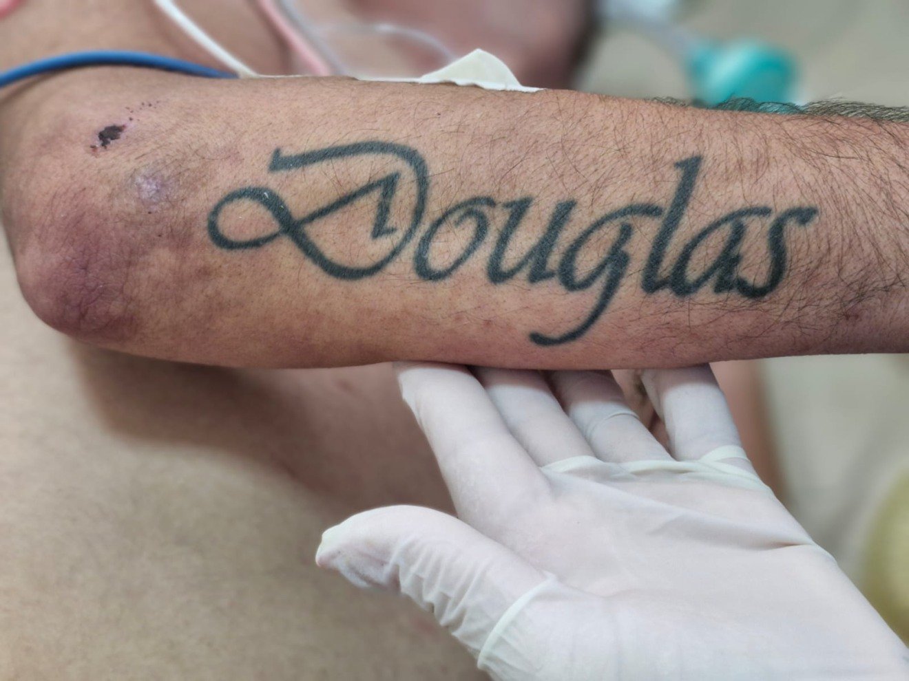 O paciente apresenta uma cicatriz visível no queixo e tem uma tatuagem no braço esquerdo com o nome Douglas. Foto: Divulgação/Hospital Auxiliadora.
