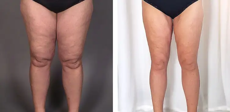 Dor nas pernas, inchaço e frustração: lipedema é mais comum do que se imagina