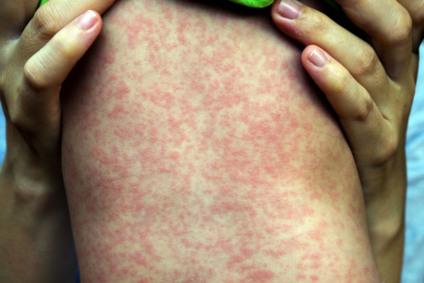 Casos mais recentes afetam crianças e jovens adultos - Foto: Reprodução/ BiologiaNet