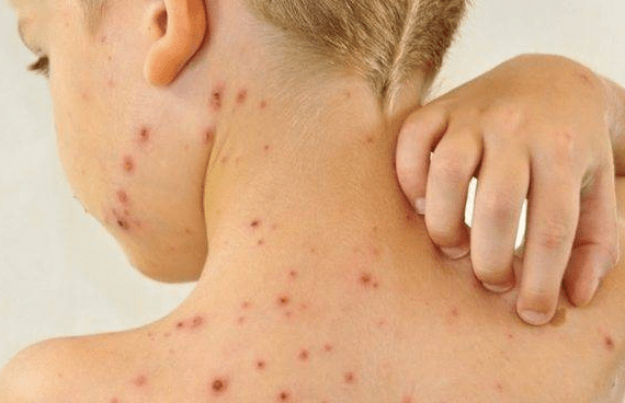 O sarampo é uma doença infecciosa grave e altamente contagiosa. Uma pessoa infectada pode transmitir o vírus para até 90% das pessoas próximas que não estejam imunizadas. Foto: Divulgação.