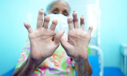 Saúde de Três Lagoas registra aumento de quase 43% nos diagnósticos de hanseníase